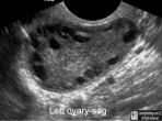 Polycystic Ovary Syndrome